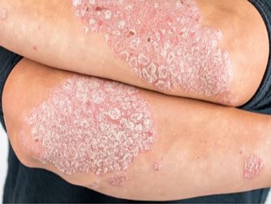 CRECE LA PSORIASIS